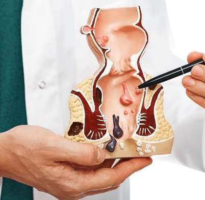 جراحیهای-هموروئید-min